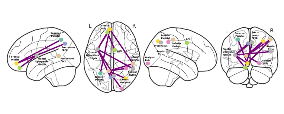 Abbildungen von Gehirnen bei akuter und chronischer CRPS mit Unterschieden der funktionellen Konnektivität. 