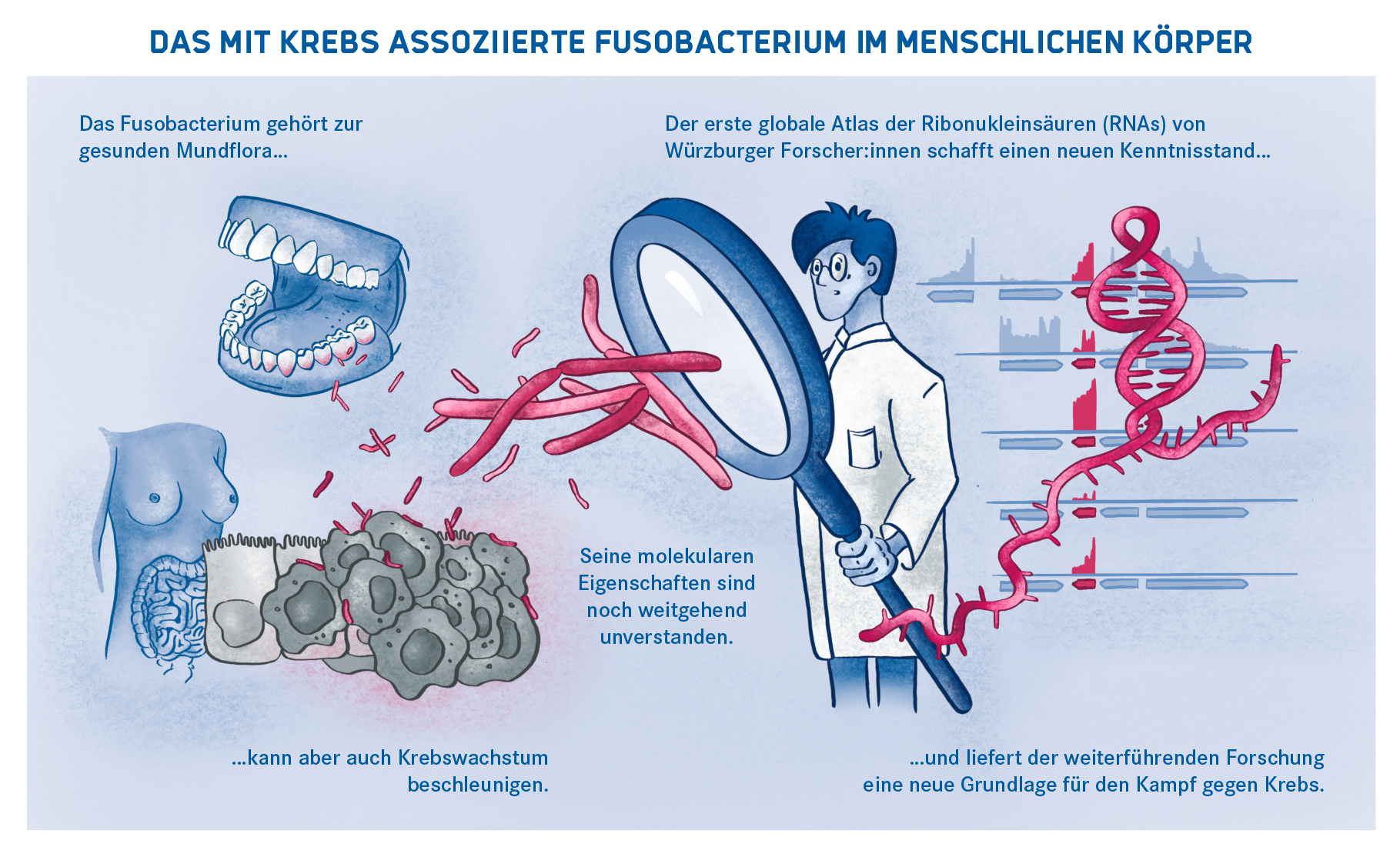 Das mit Krebs assoziierte Fusobacterium im menschlichen Körper Das mit Krebs assoziierte Fusobacterium im menschlichen Körper