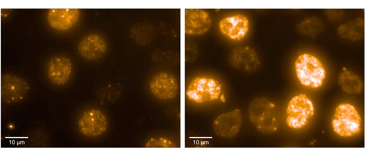 Neuroblastomzellen unter dem Mikroskop