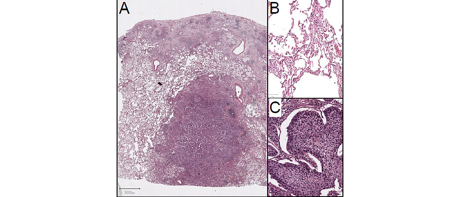 Bild zeigt eine Hematoxylin-Eosin-Färbung eines Plattenepitheltumors aus der Lunge 