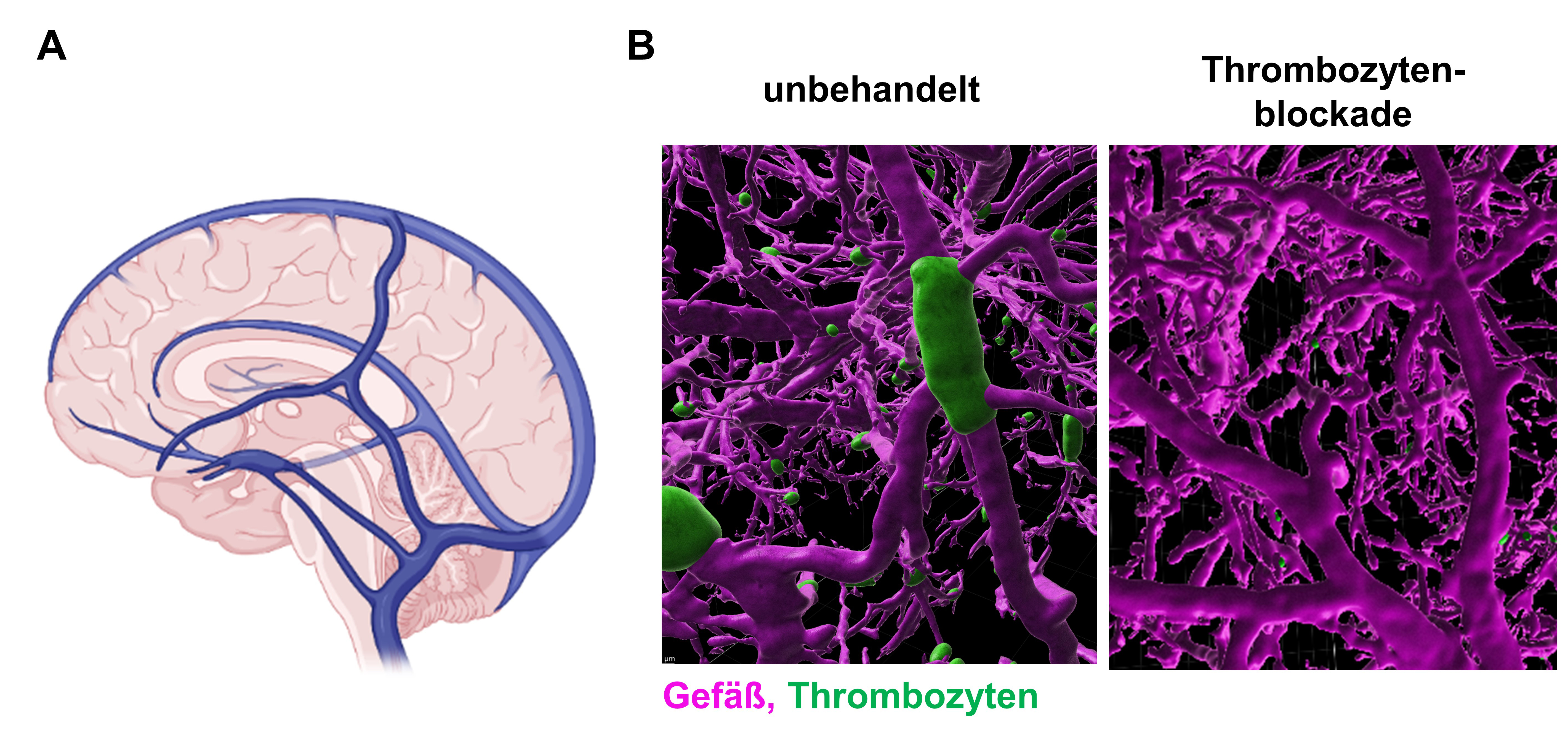 Bild A) zeigt eine schematische Darstellung der großen Hirnvenen. Bild B) zeigt Gefäß, Thrombozyten unbehandelt und eines deren Thrombozyten gehemmt wurde.