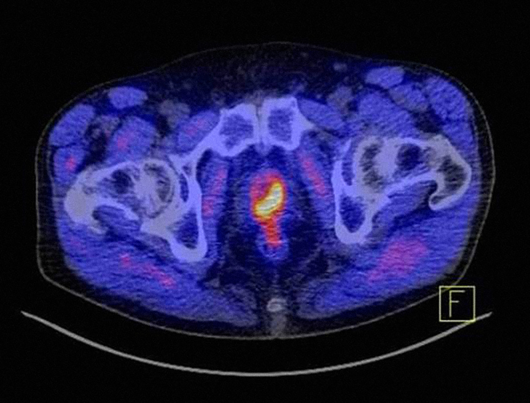 Die Abbildung zeigt, wie markant ein Prostatakarzinom unter Zuhilfenahme des Tracers PSMA im PET-CT als gelb-rotes Objekt dargestellt wird.
