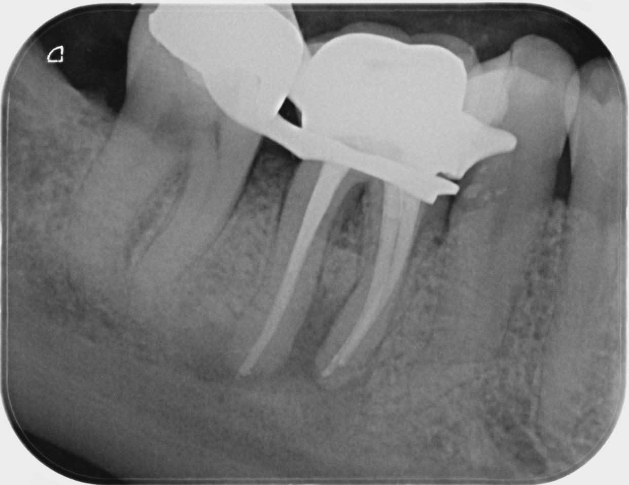 Ein Beispiel für eine exzellente endodontische Leistung: Die preiswürdige, von Lisanne Carnier durchgeführte Wurzelkanalbehandlung.