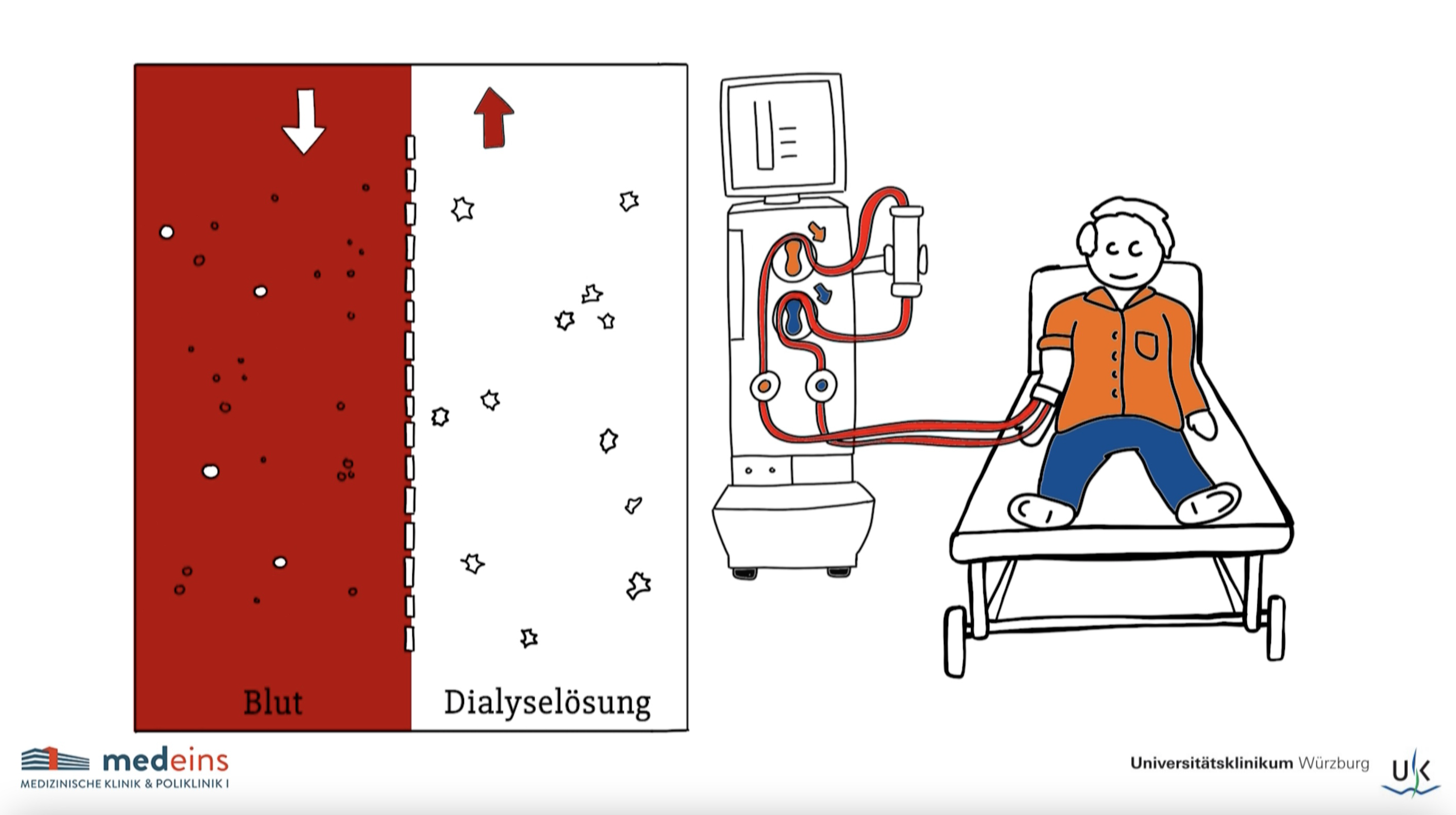 Screenshot vom Patientenfilm: Kann eine Standard-Dialysat-Natriumkonzentration von 137 mmol/l verglichen mit 140 mmol/l kardiovaskuläre Ereignisse und Todesfälle bei erwachsenen Hämodialysepatientinnen und -patienten verringern?