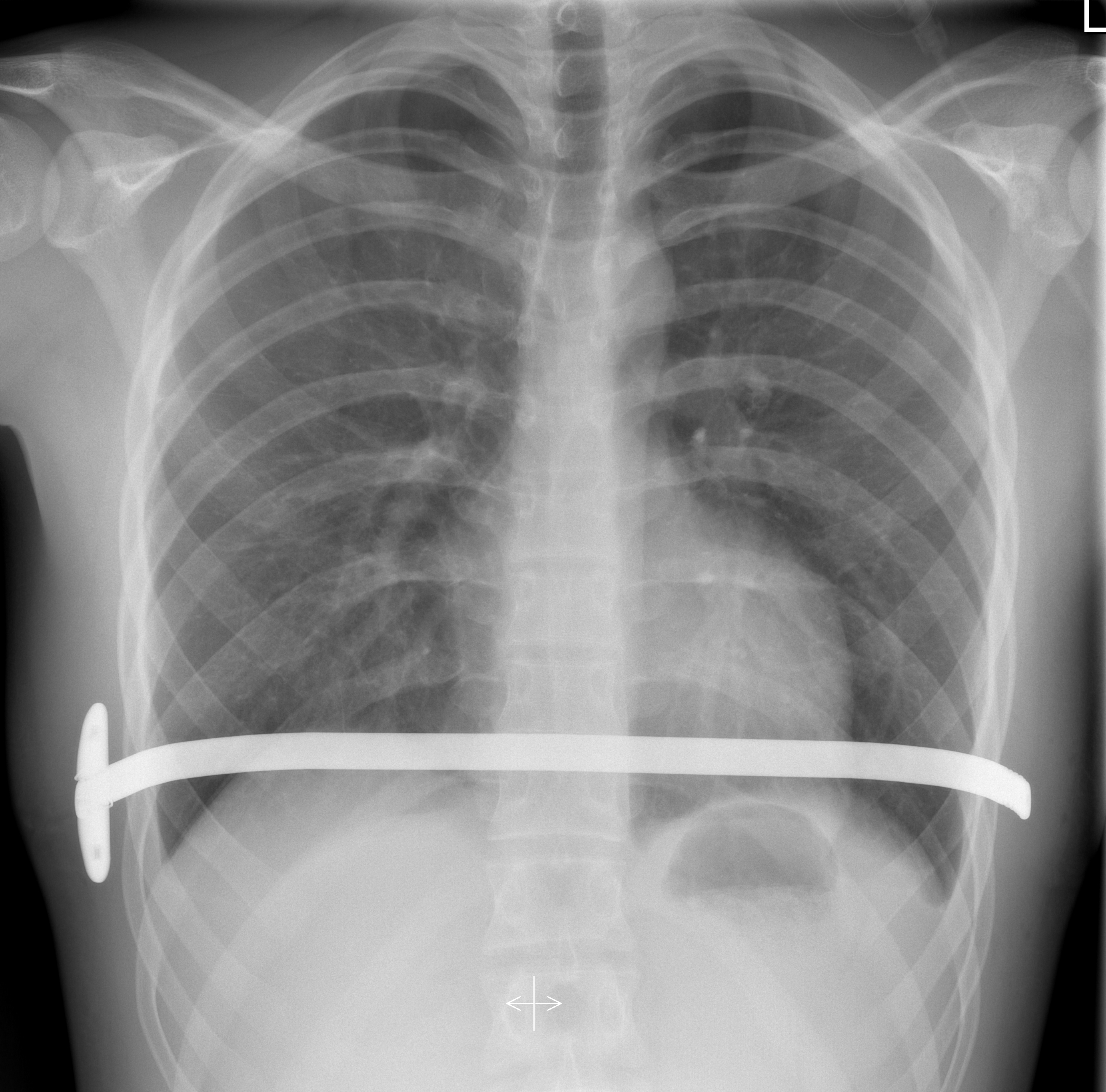 Das Röntgenbild zeigt den Bügel, der nach der Nuss-OP das Brustbein anhebt.