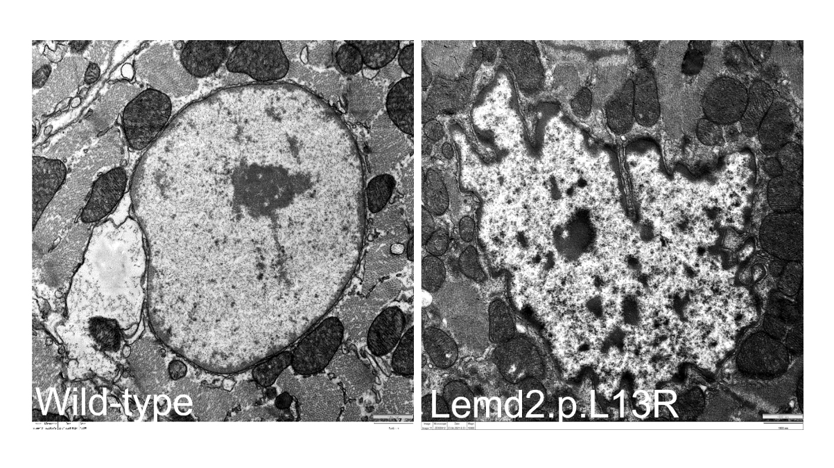 Die Abbildung zeigt links die Aufnahme des runden Kerns einer gesunden Herzmuskelzelle und rechts den Zellkern eines Herzens mit LEMD2-Mutation, an denen die Einstülpungen deutlich zu erkennen sind. 