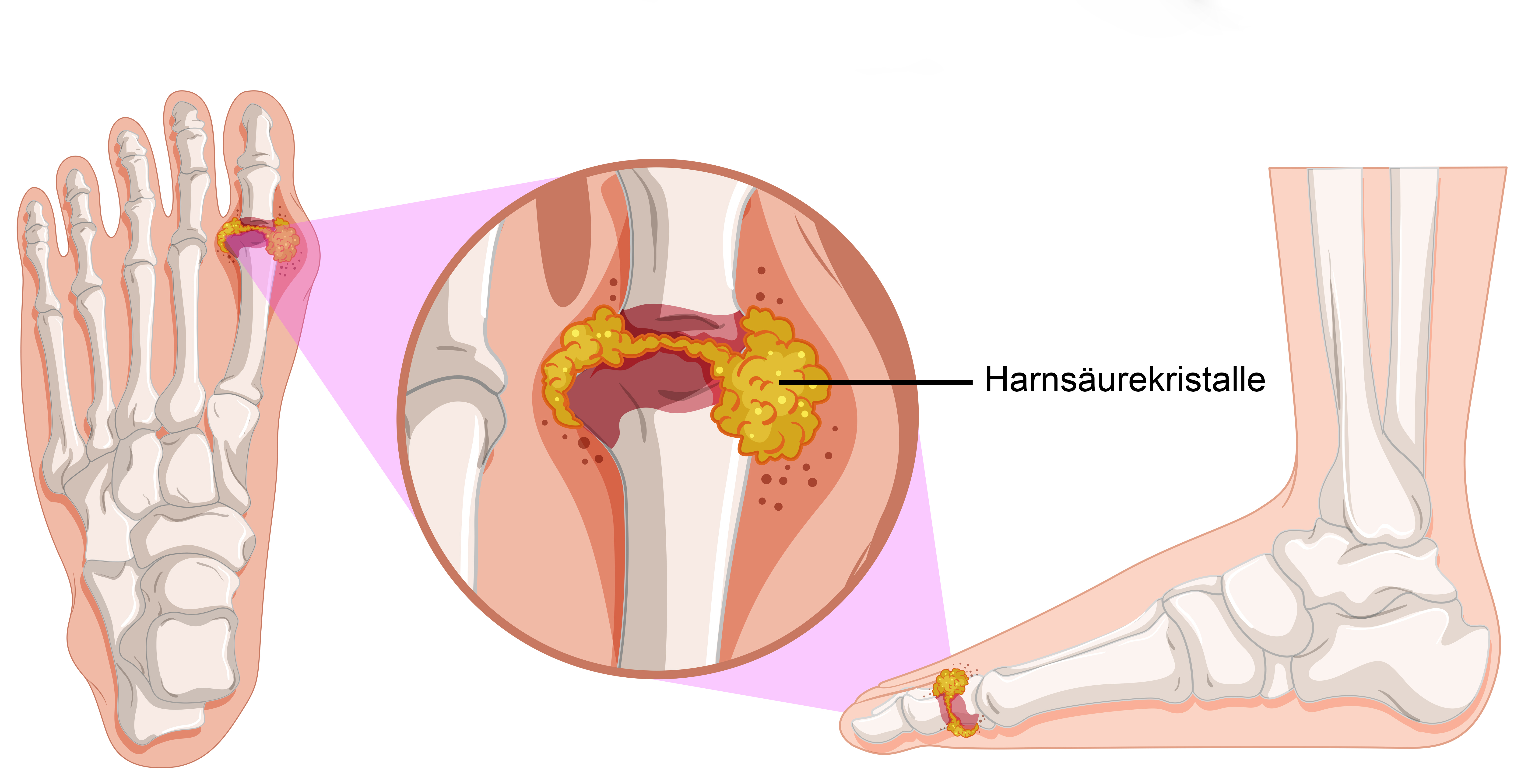 Das Bild zeigt die Ablagerungen der Harnsäurekristalle an Fingern und Füßen