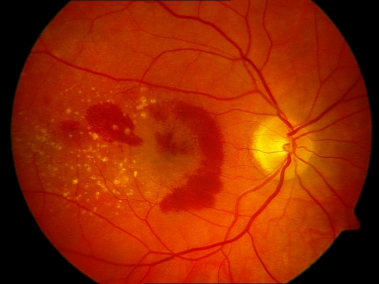 Bei der feuchten altersbedingten Macula-Degeneration wird die Netzhaut durch Blutungen und Flüssigkeitseinlagerungen geschädigt.