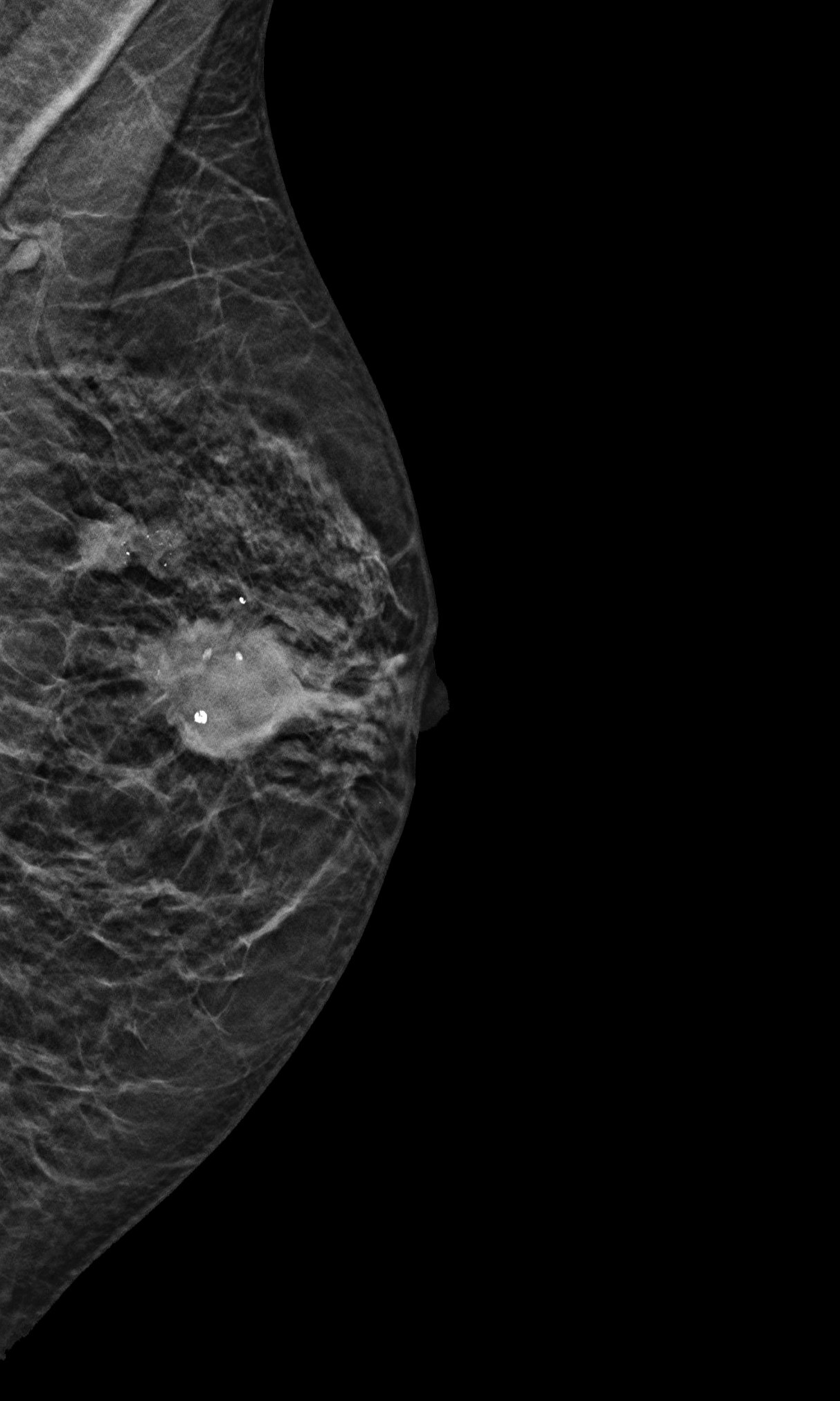 Mammographie-Bild zeigt mehrere Herde und bösartige Verkalkungen