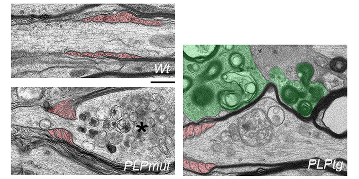 Elektronenmikroskopische Aufnahmen von Axonen in der weißen Substanz von gesunden Kontroll-Mäusen (links oben) und von Mäusen mit verschiedenen Myelin-Gendefekten. Axone, die mit abnormem Myelin umwickelt bleiben (links unten), werden von Fortsätzen der Oligodendrozyten (rot gefärbt) eingeschnürt und weisen Merkmale der Degeneration auf (Stern). Im Gegensatz dazu haben Axone, deren Myelin durch Mikroglia (grün gefärbt, rechtes Bild) entfernt wird, eine höhere Chance zu überleben. Größenmaßstab: 0,5 µm.