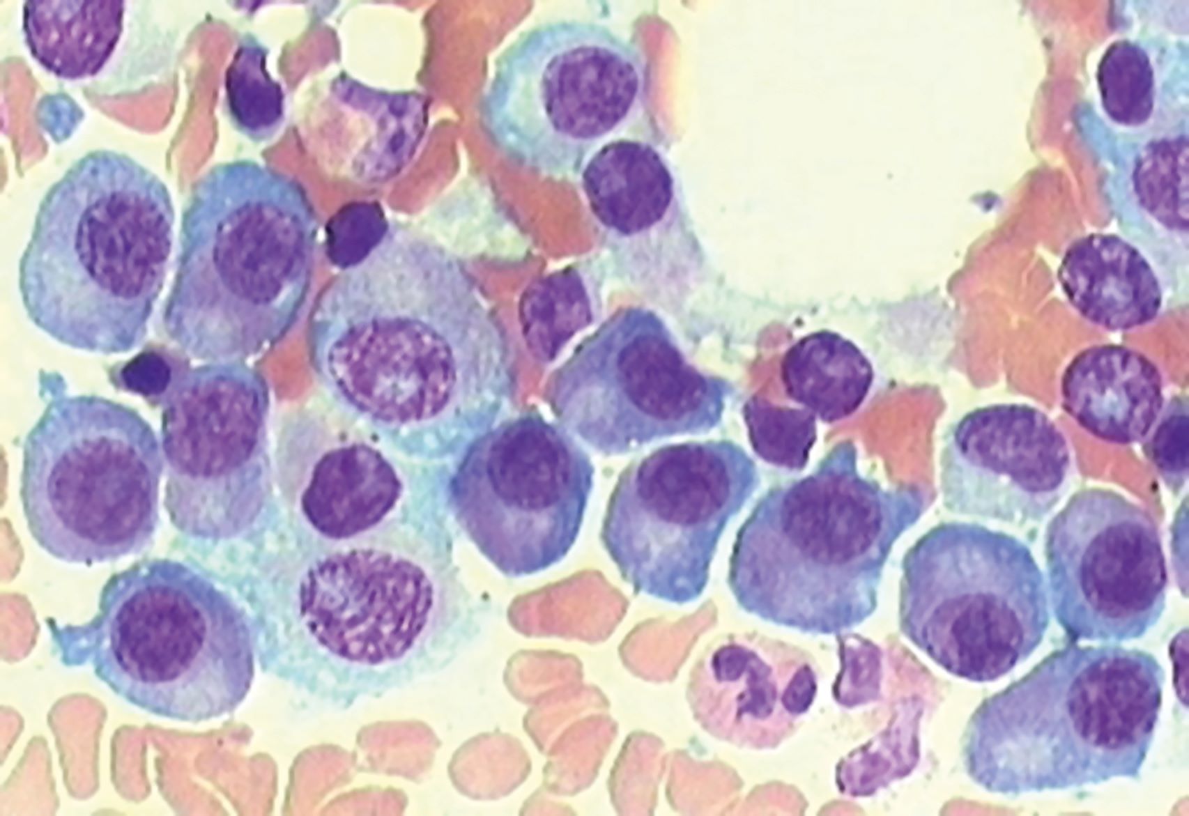 Myelom-Zellpräparat eines Patienten mit violetten Plasmazellen