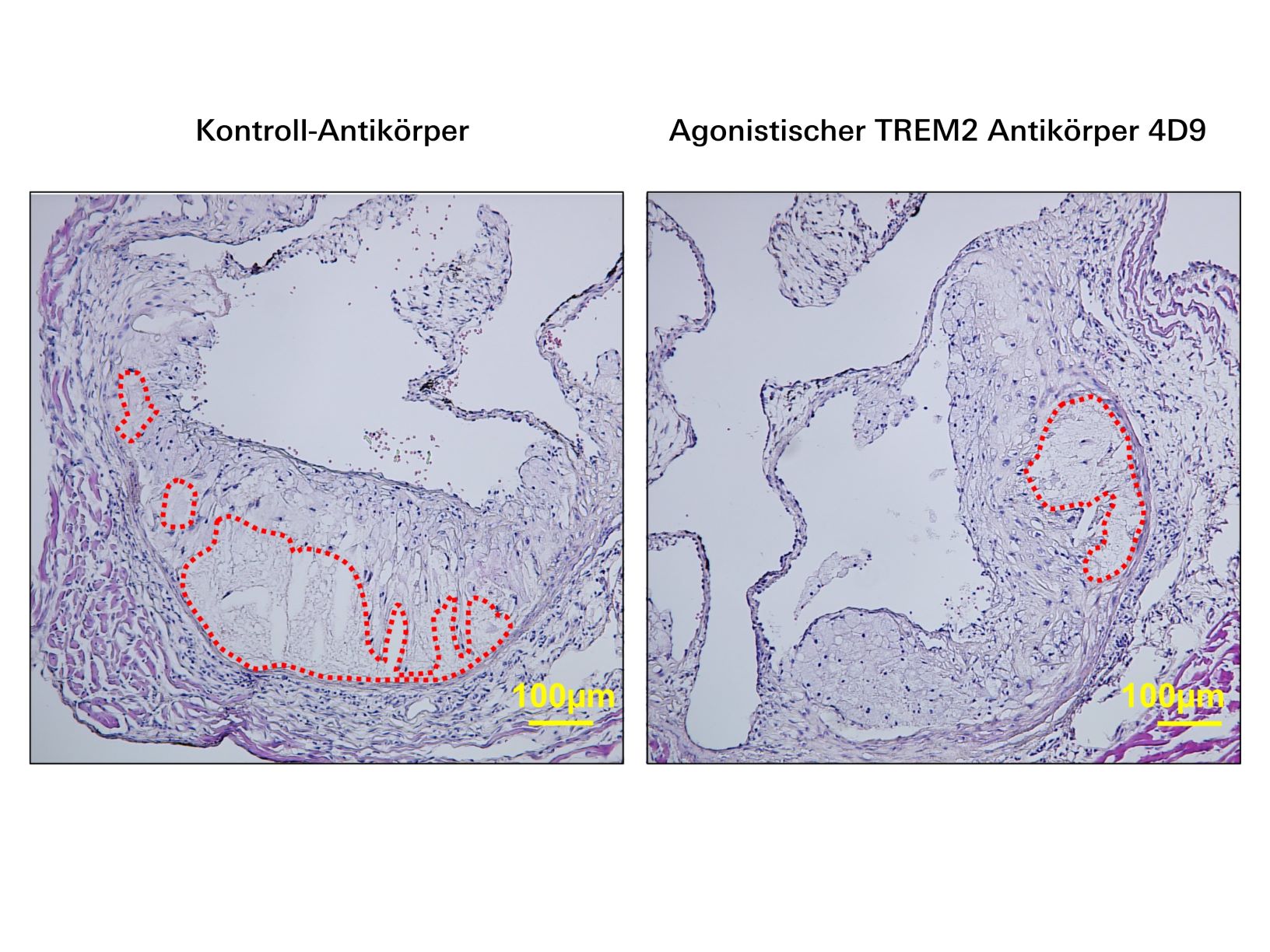 Agonistischer TREM2-Antikörper mit atheroprotektiver Funktion