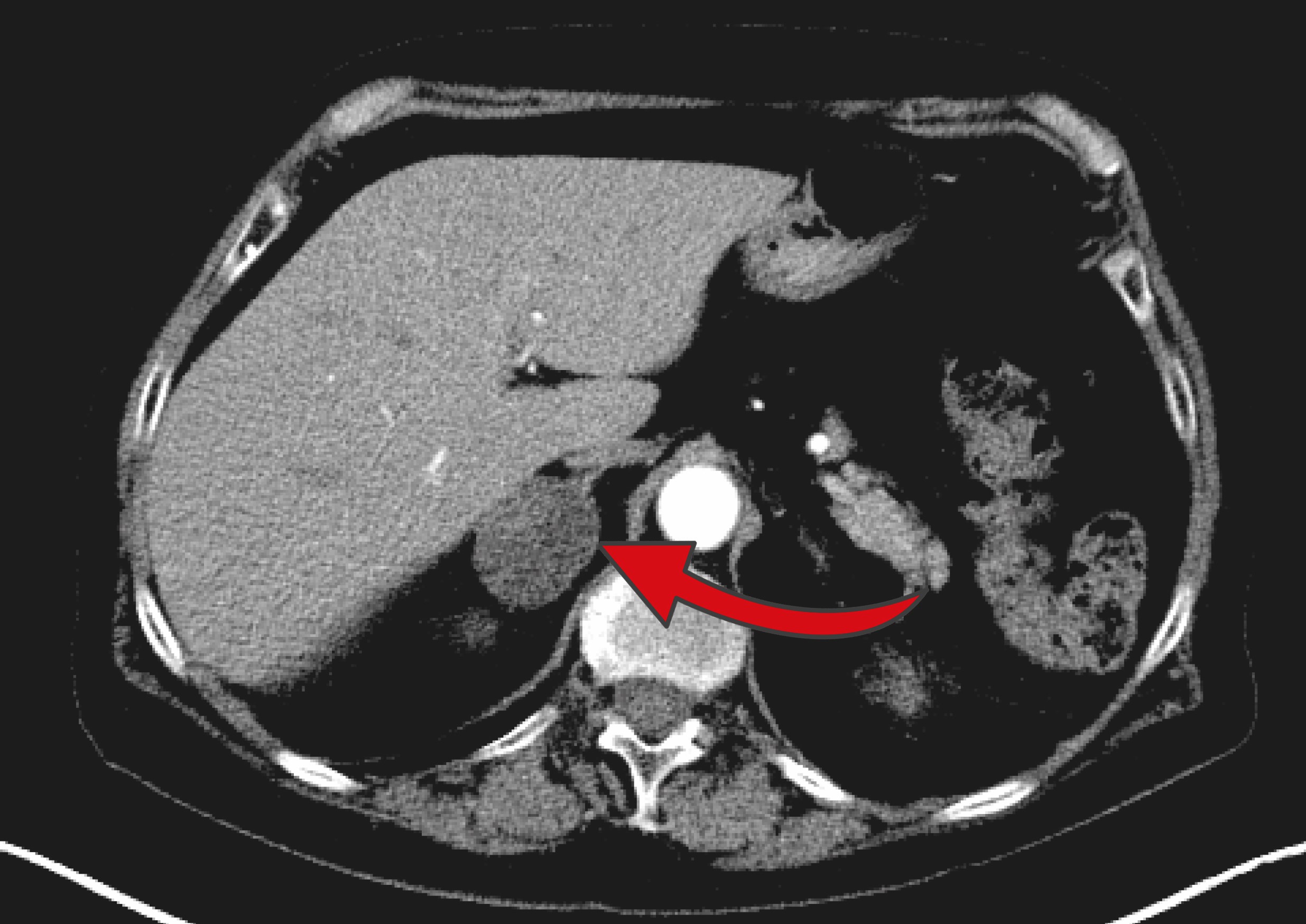 MRT-Aufnahme eines Nebennierentumors - ein roter Pfeil zeigt auf den Tumor 
