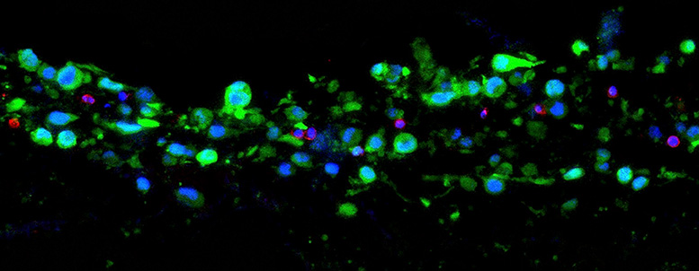 Immunzellen (rot) attackieren Brustkrebszellen (grün) in einem 3D-Gewebemodel
