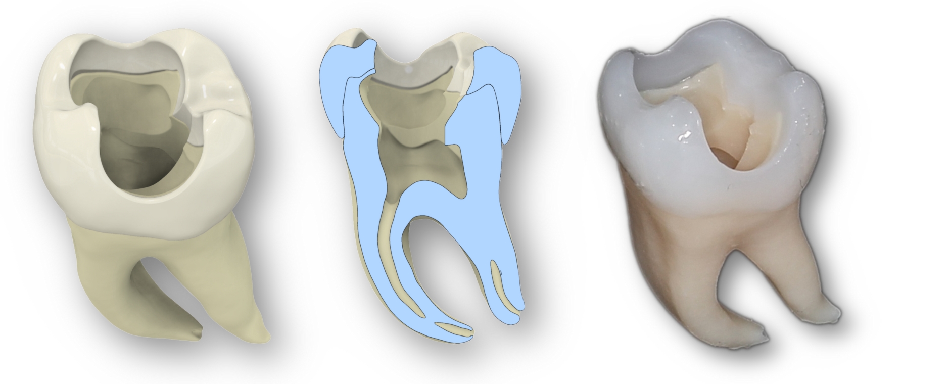 2 Ansichten eines 3D-gedruckten Zahnes und eines Querschnitts