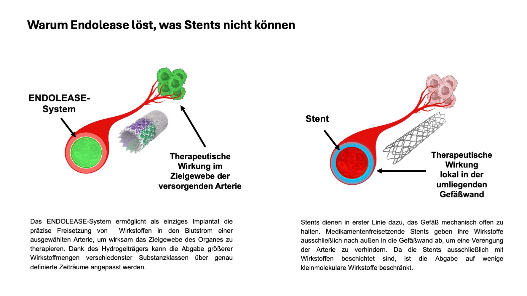Die Grafik zeigt, was ENDOLEASE kann, was Stents nicht können, nämlich Wirkstoffe in die Arterie abgeben, Stent hält Gefäß offen und gibt Wirkstoffe in die umliegende Gefäßwand ab, aber nicht in den Blutfluss. 