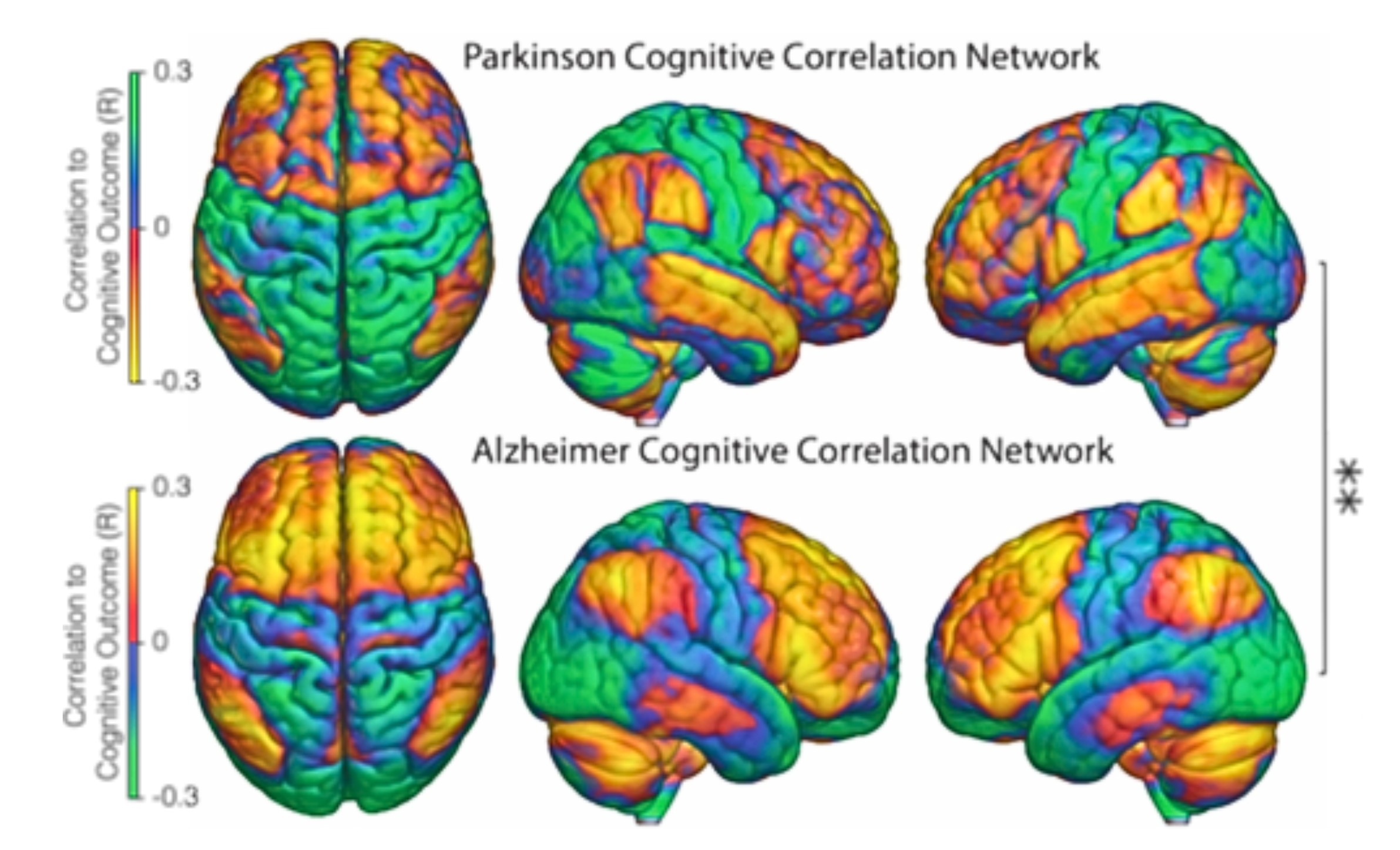 Verschiedene Hirnkarten von Patienten mit Alzheimer und mit Parkinson. 