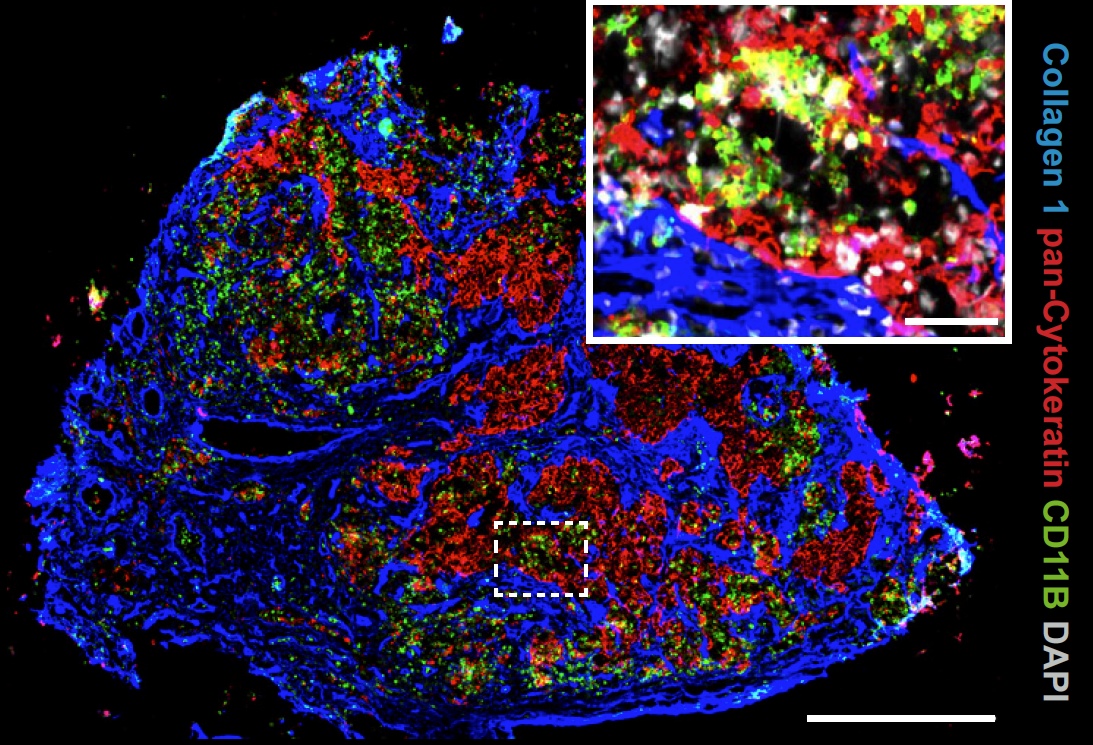 Immunfluoreszenzaufnahme einer Lymphknotenmetastase. Deutlich erkennbar ist die enge räumliche Interaktion von Tumorzellen, fibroblastischen Retikulumzellen und myeloiden Zellen. Grün markiert sind CD11B-positive myeloide Zellen, rot Pan-Cytokeratin-positive Brustkrebszellen (epithelialen Ursprungs), und blau Kollagen I, das von fibroblastischen Retikulumzellen gebildet wird. Maßstabsbalken: 500 µm, Inlay: 30 µm.