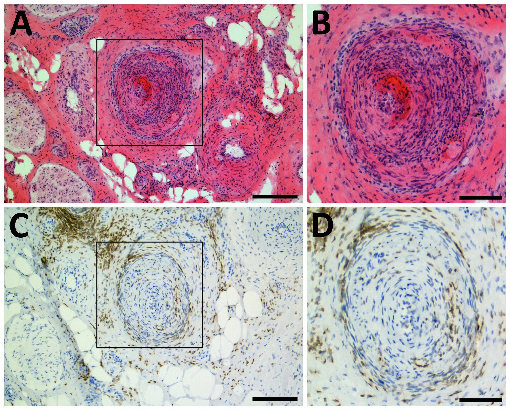 Die oberen Bilder der Nervus suralis-Biopsie wurden mit Hämalun und Eosin pink angefärbt, bei den unteren farblosen Bildern ist eine CD3-Immunhistochemie zu sehen. 