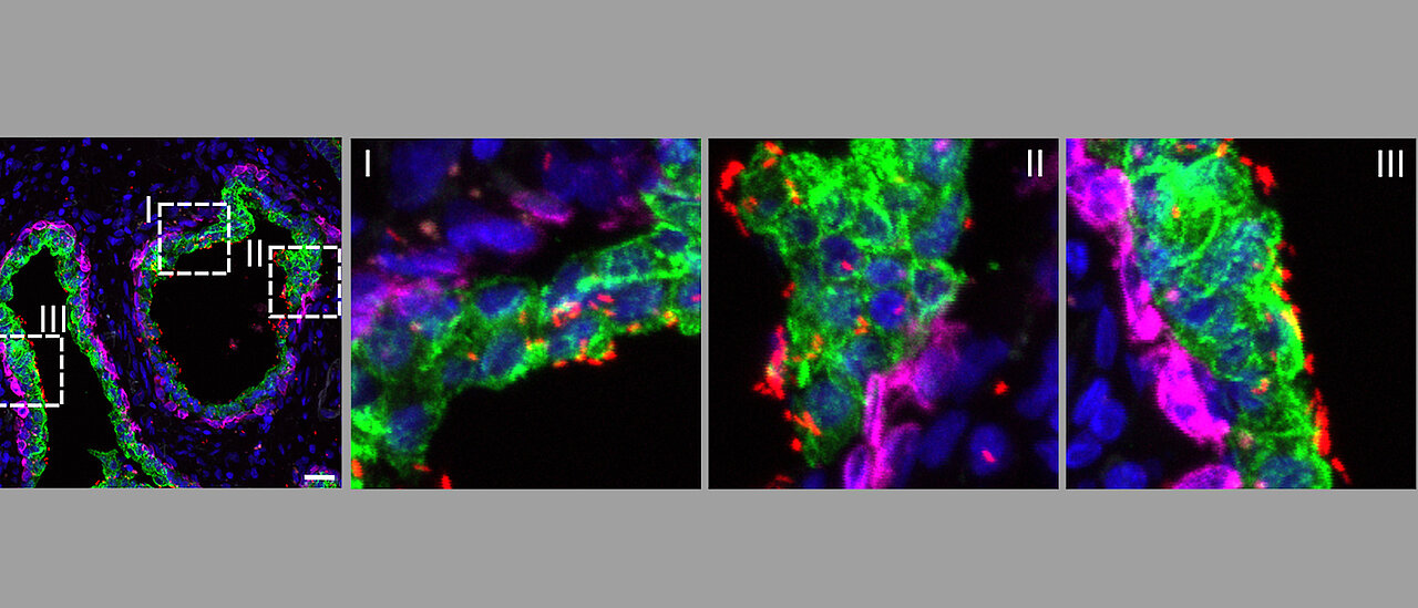Konfokalmikroskopie-Bilder: Die E. coli haften bevorzugt an luminalen Prostatazellen im menschlichen Prostatagewebe.