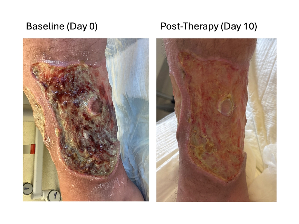 Chronische Wunden vor der Behandlung mit Probiotika und nach den 10 Therapietagen.