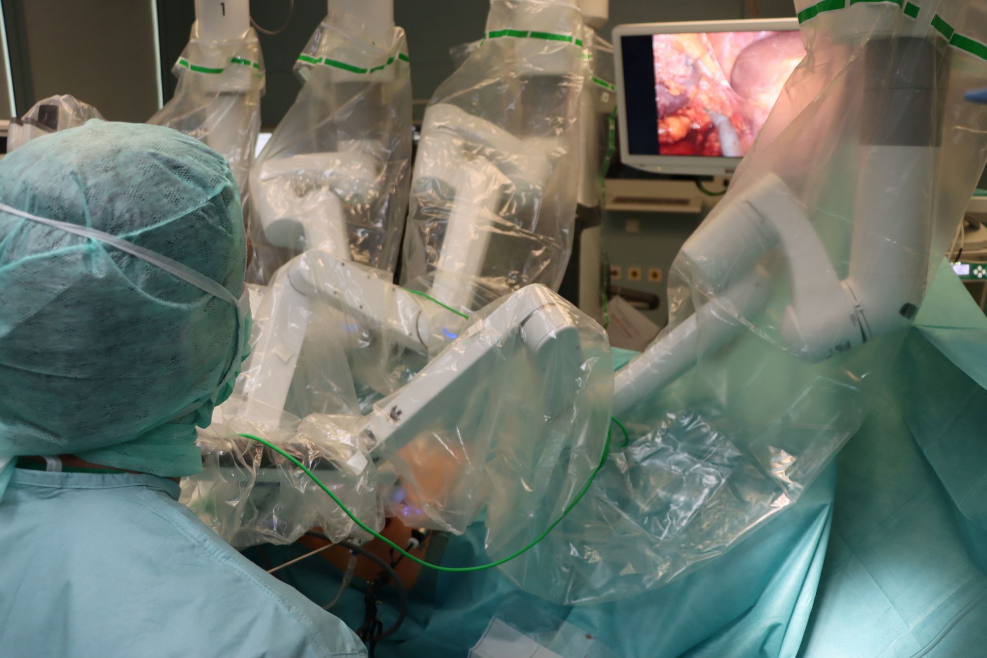 Mit dem DaVinci-Operationsroboter lassen sich Nierenkrebs-Operationen minimalinvasiv und damit äußerst schonend durchführen