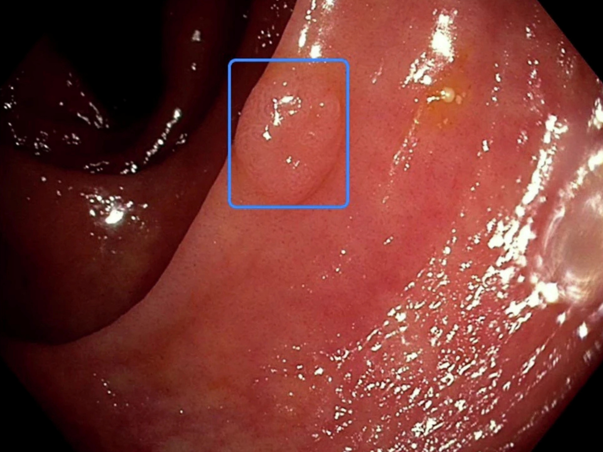 Bei einer Koloskopie wird ein Polyp mit einem blauen Rechteck markiert. 