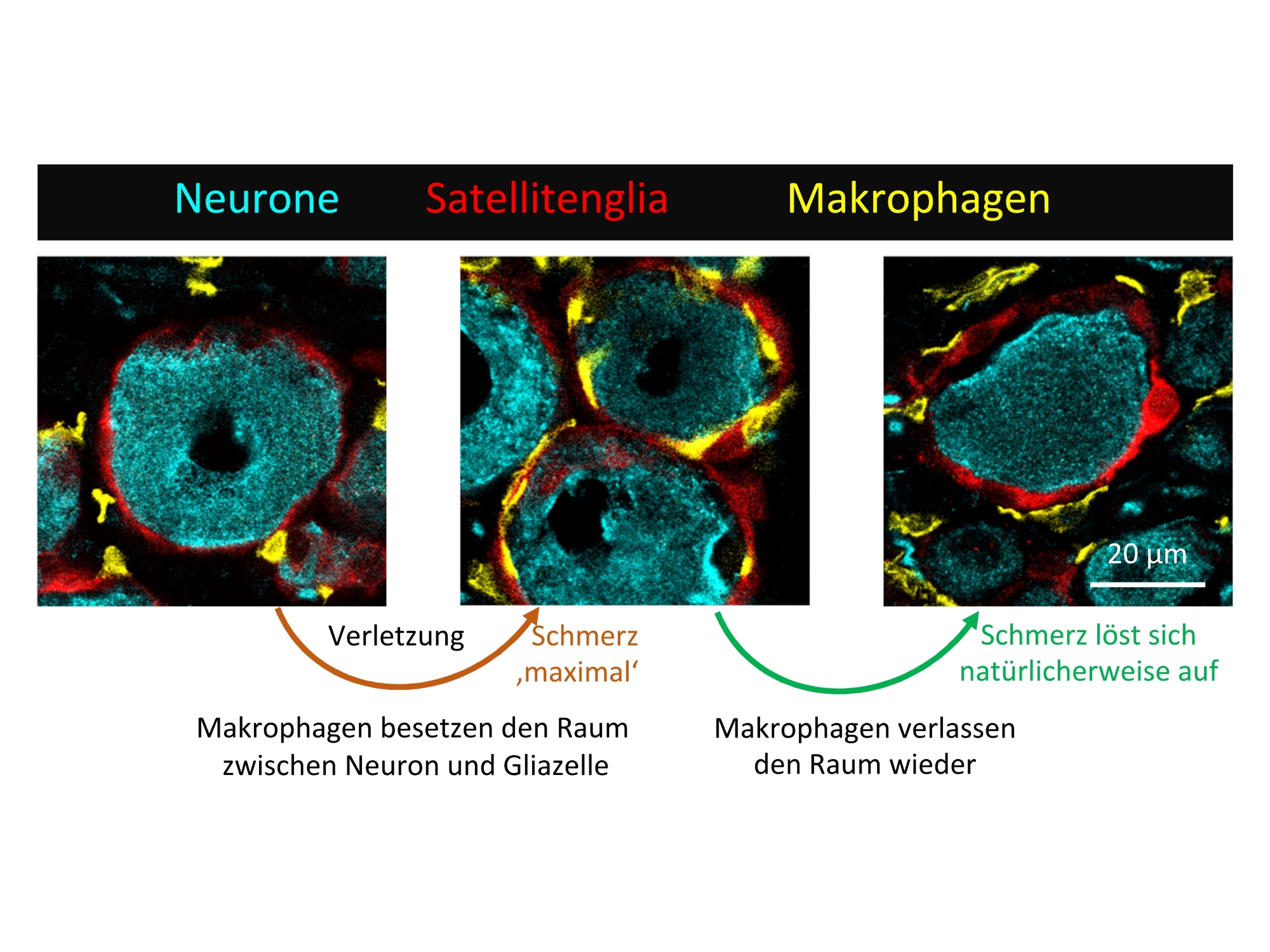 Drei mikroskopische Bilder, die die Studie zusammenfassen - von der Verletzung in den Schmerz und Schmerzauflösung. Makrophagen besetzen Raum zwischen Neuron und Gliazelle und verlassen den Raum bei der Schmerzauflösung wieder. 
