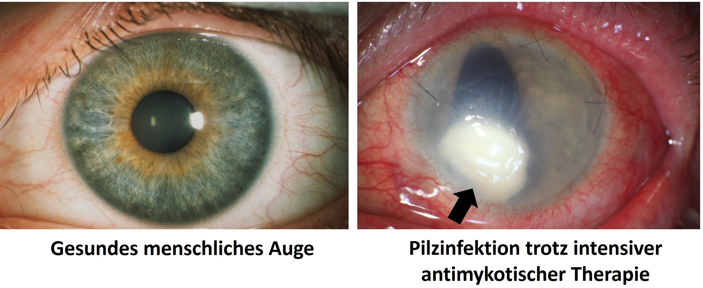 Collage mit zwei Bildern, links ein gesundes menschliches Auge und rechts ein Auge mit einer Pilzinfektion trotz intensiver Therapie - vor der Pupille ist ein weißer Klecks, der die Sicht einschränkt. 