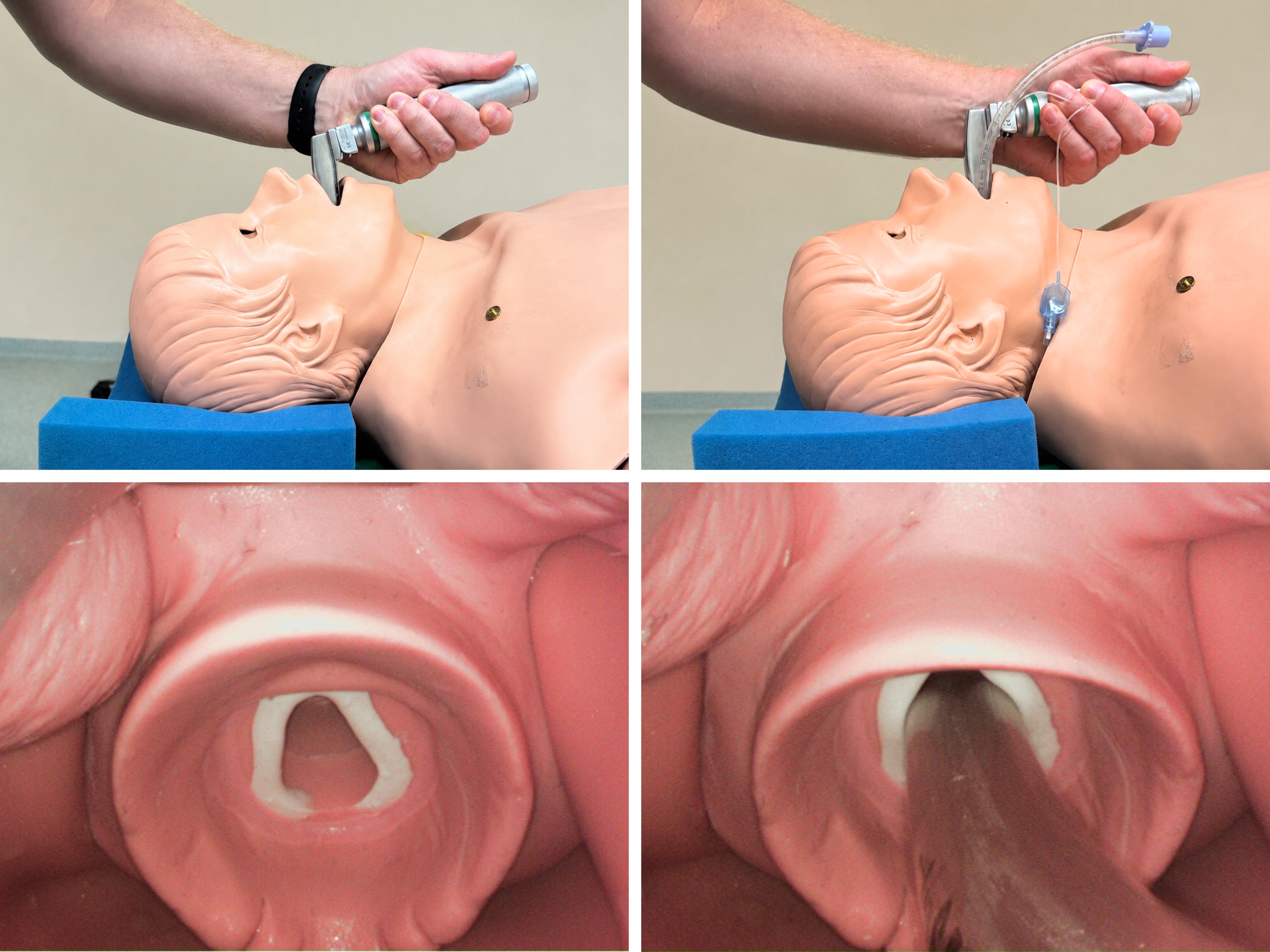 Collage mit vier Bildern an einer Patientenpuppe - Laryngoskopie- und Intubationsvorgang
