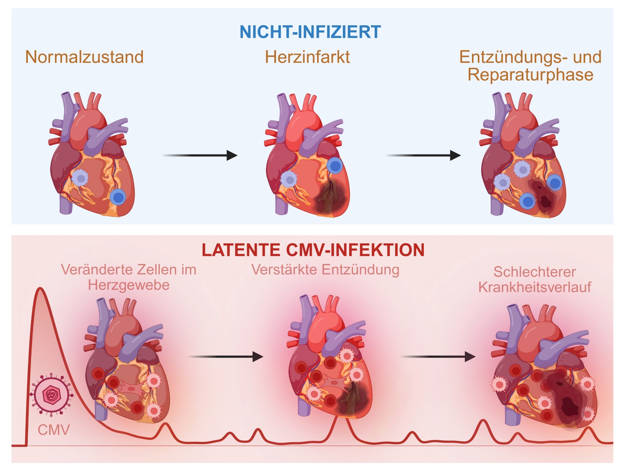 Oben der Verlauf eines Herzinfarktes bei einer nicht CMV-infizierten Person: Normalzustand, Herzinfarkt, Entzündungs- und Reparaturphase; unten der Verlauf bei einer latenten CMV-Infektion: Veränderte Zellen im Herzgewebe, verstärkte Entzündung und schlechterer Krankheitsverlauf. 