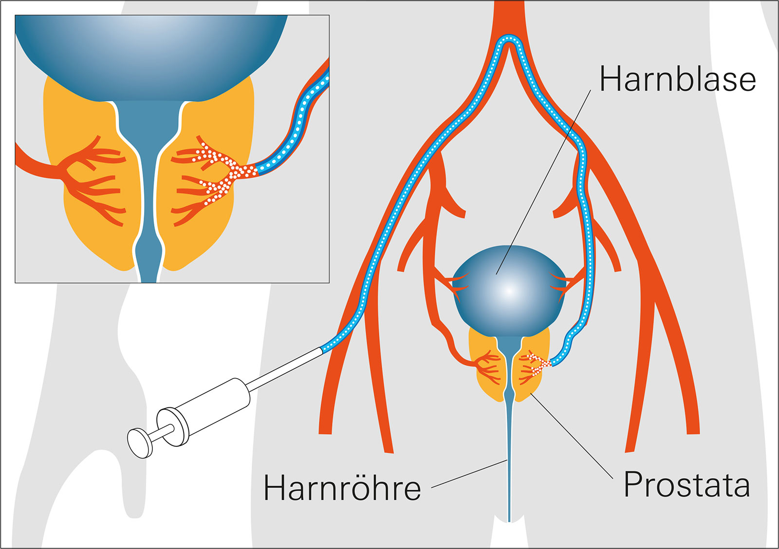 schematische Darstellung zum Verfahren einer Prostata-Arterienembolisation