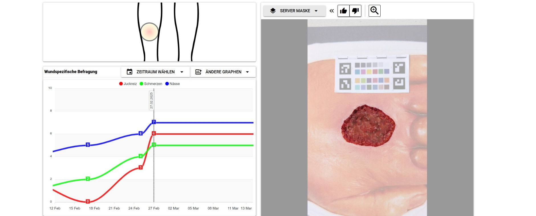 Das Bild zeigt einen Screenshot des Dashboards für Ärzte, oben der abfotografierte Bereich des Körpers, rechts die Wunde mit Referenzkarte und unten links die Kurven der verschiedenen Skalen. rechts 