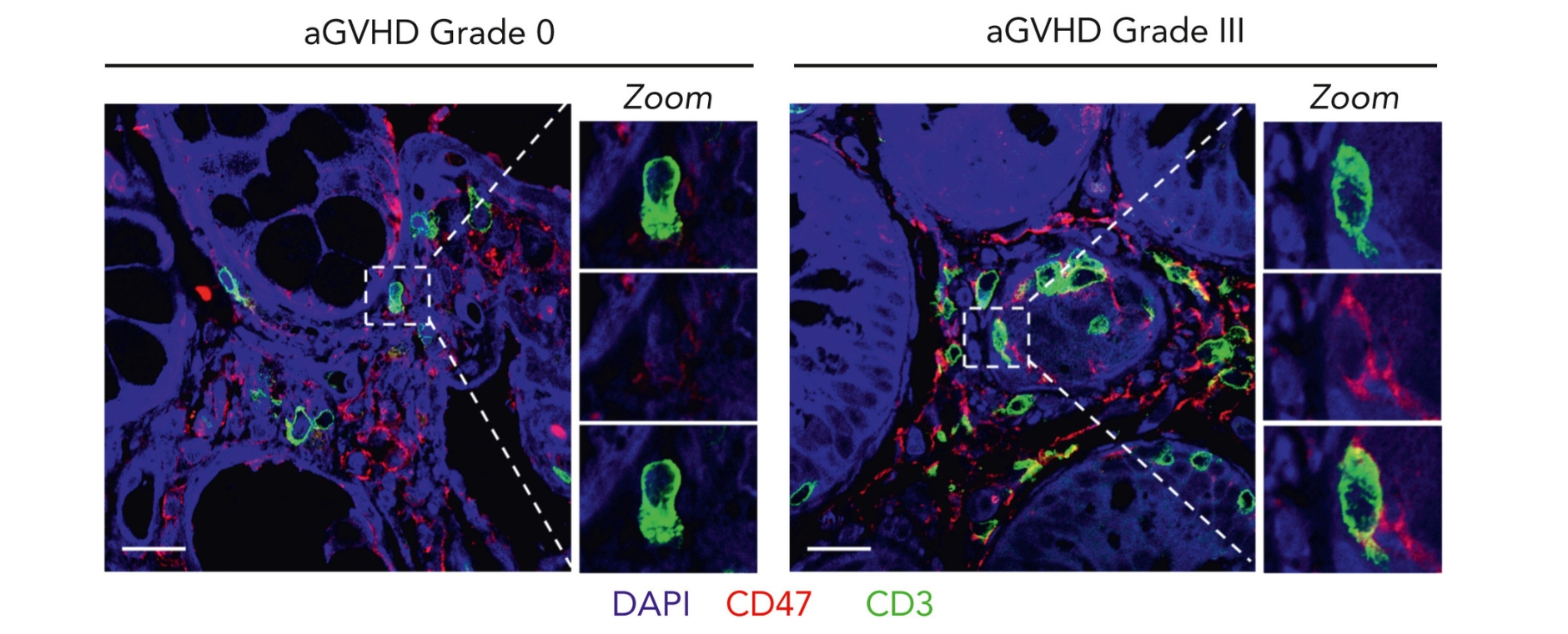 Alloreaktive T-Zellen  Konfokalmikroskopie von Darmbiopsien von Patientinnen und Patienten mit akuter GvHD (aGvHD) des Lerner-Grades 0 bzw. 3, repräsentativ für jeweils mindestens fünf Personen pro Gruppe. Paraffineingebettete Gewebeschnitte wurden mit Anti-CD3 AF488 (grün), Anti-CD47 AF568 (rot) und DAPI (4′,6-Diamidino-2-phenylindol; blau) gefärbt. Maßstabsbalken: 20 µm.