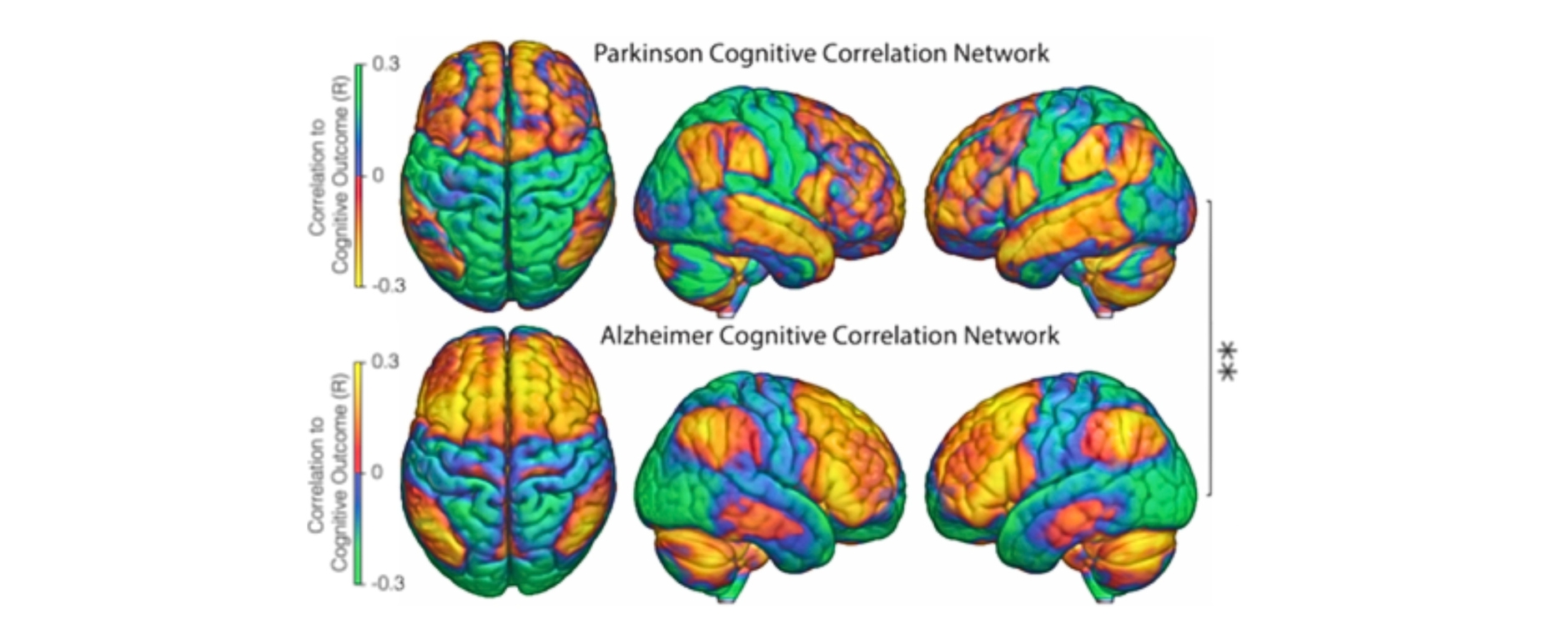 Hirnnetzwerke bei Parkinson und Alzheimer Die Grafik zeigt verschiedene Abbildungen von Hirnnetzwerken bei Parkinson und Alzheimer mit farblich markierten Bereichen der stimulierten Gegenden.