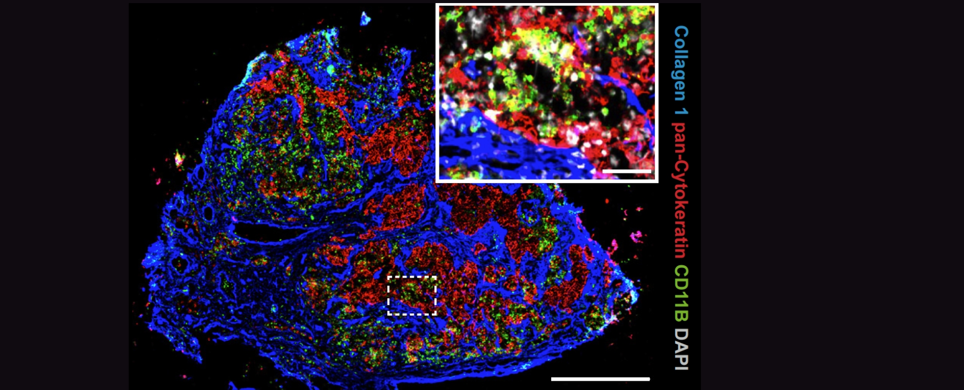 Immunfluoreszenzbild Lymphknotenmetastase Immunfluoreszenzbild einer Lymphknotenmetastase und ein vergrößerter Ausschnitt aus dem Bild.