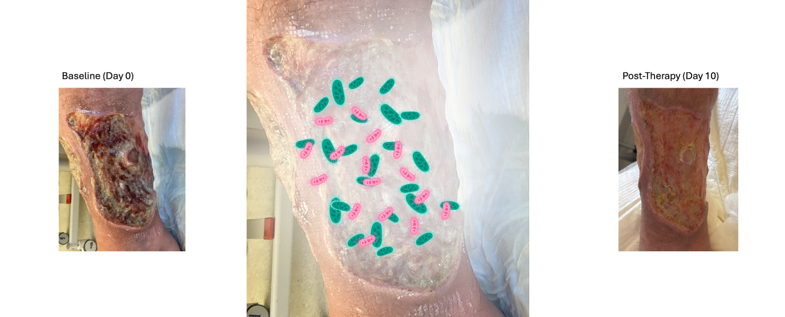 Aufnahme einer chronischen Wunde vor der Behandlung und 10 Tage später, in denen die Wunde mit Milchsäurebakterien behandelt wurde. 