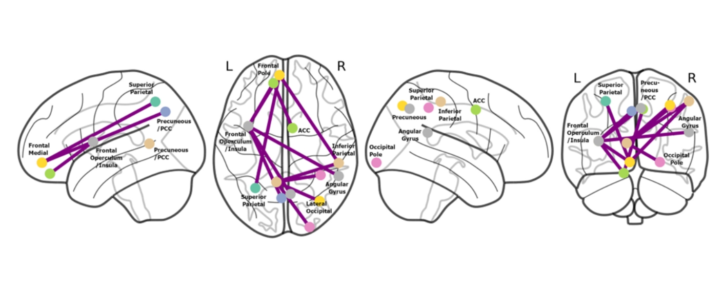 Abbildungen von Gehirnen bei akuter und chronischer CRPS mit Unterschieden der funktionellen Konnektivität. 