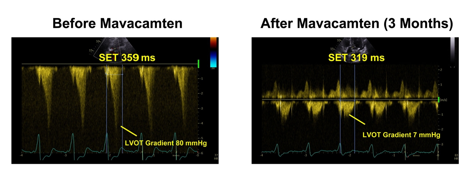 2 Bilder der LVOT-Gradienten