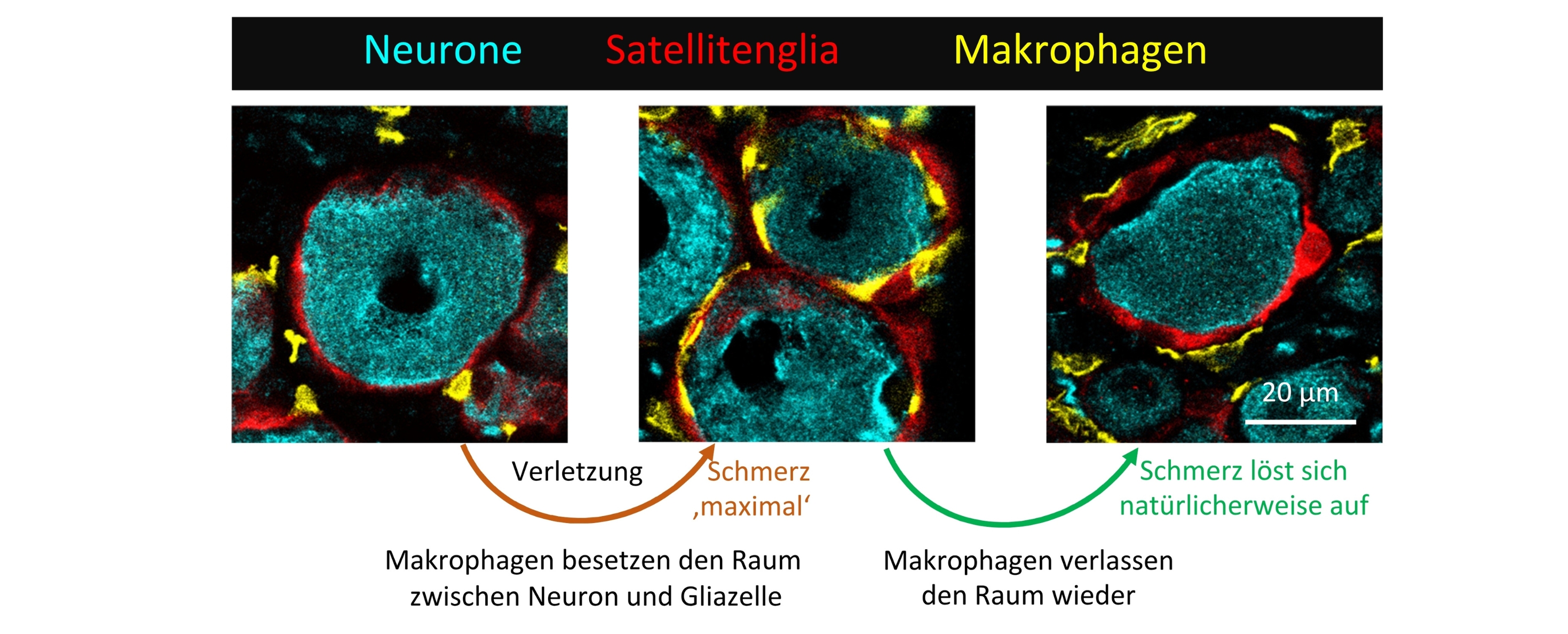 Grafische Zusammenfassung der Schmerzrückbildung  von Verletzung über maximalem Schmerz bis zur Schmerzauflösung - Makrophagen besetzten erst den Raum zwischen Neuron und Gliazelle, dann verlassen sie ihn wieder.